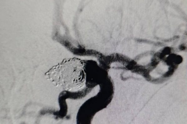 Волгоградские медики спасли пациентку с тяжёлой патологией головного мозга