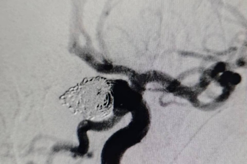 Волгоградские медики спасли пациентку с тяжёлой патологией головного мозга