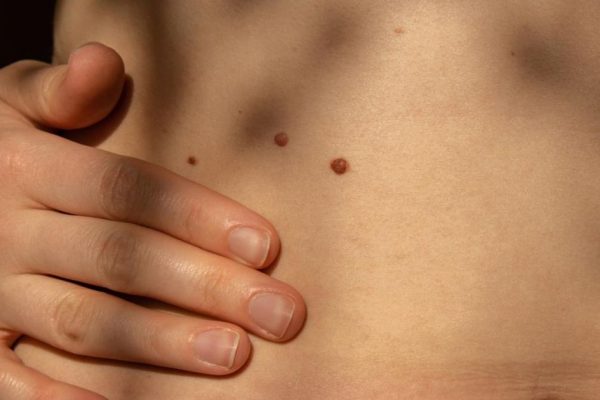 Родинка под прицелом: онколог объяснил, кто в группе особого риска