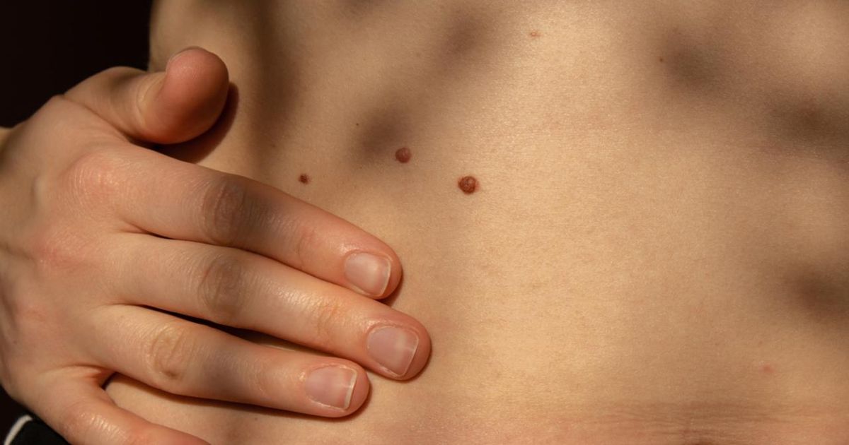 Родинка под прицелом: онколог объяснил, кто в группе особого риска