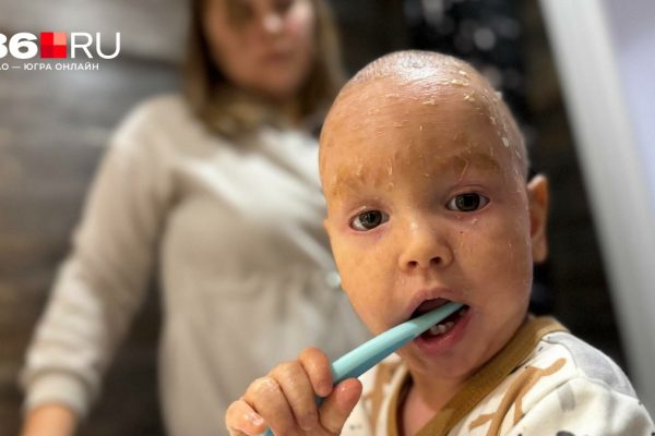 Окружающие разглядывают его с опаской. Как живет мальчик с «болезнью рыбьей чешуи»: видео