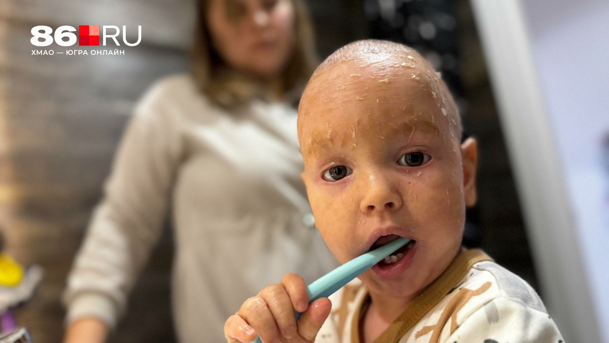 Окружающие разглядывают его с опаской. Как живет мальчик с «болезнью рыбьей чешуи»: видео