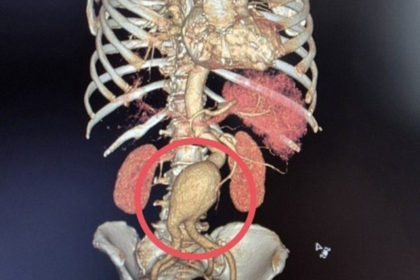 Саратовские хирурги спасли пациентку с тяжёлой сосудистой патологией