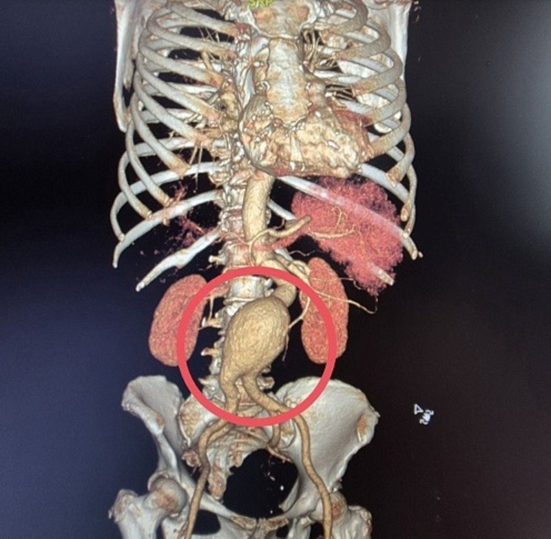 Саратовские хирурги спасли пациентку с тяжёлой сосудистой патологией